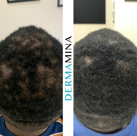 Hair Loss Treatment Before and After