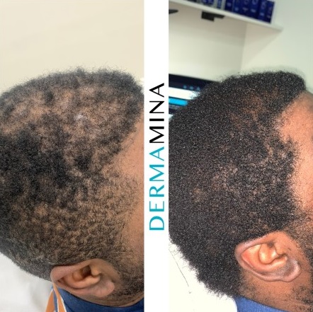 Hair Loss Treatment Before and After