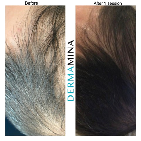 Hair Loss Treatment Before and After