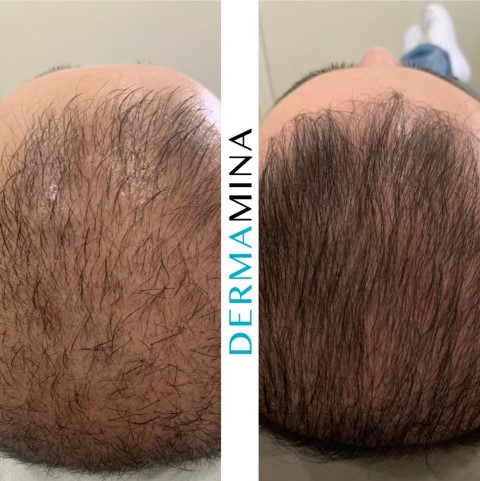 Hair Loss Treatment Before and After