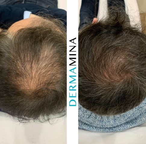 Hair Loss Treatment Before and After