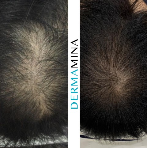 Hair Loss Treatment Before and After