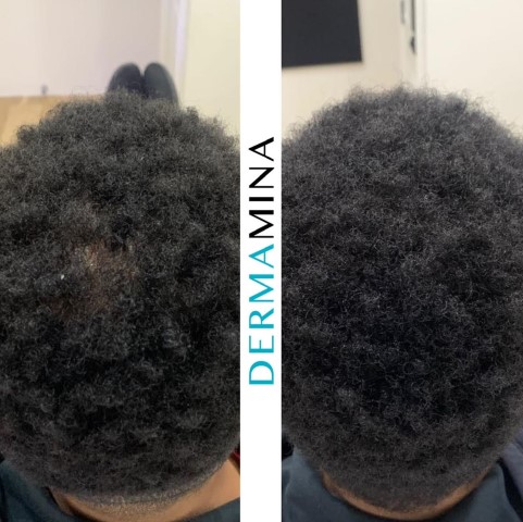 Hair Loss Treatment Before and After