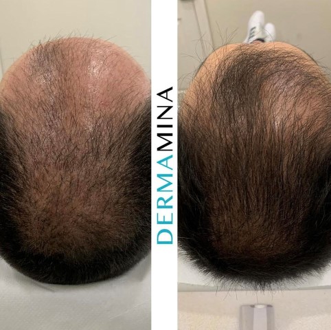 Hair Loss Treatment Before and After