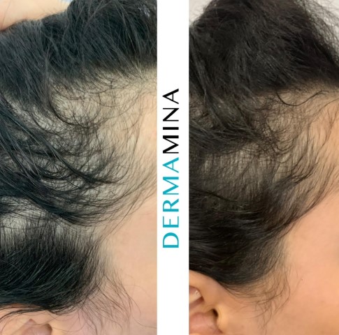 Hair Loss Treatment Before and After