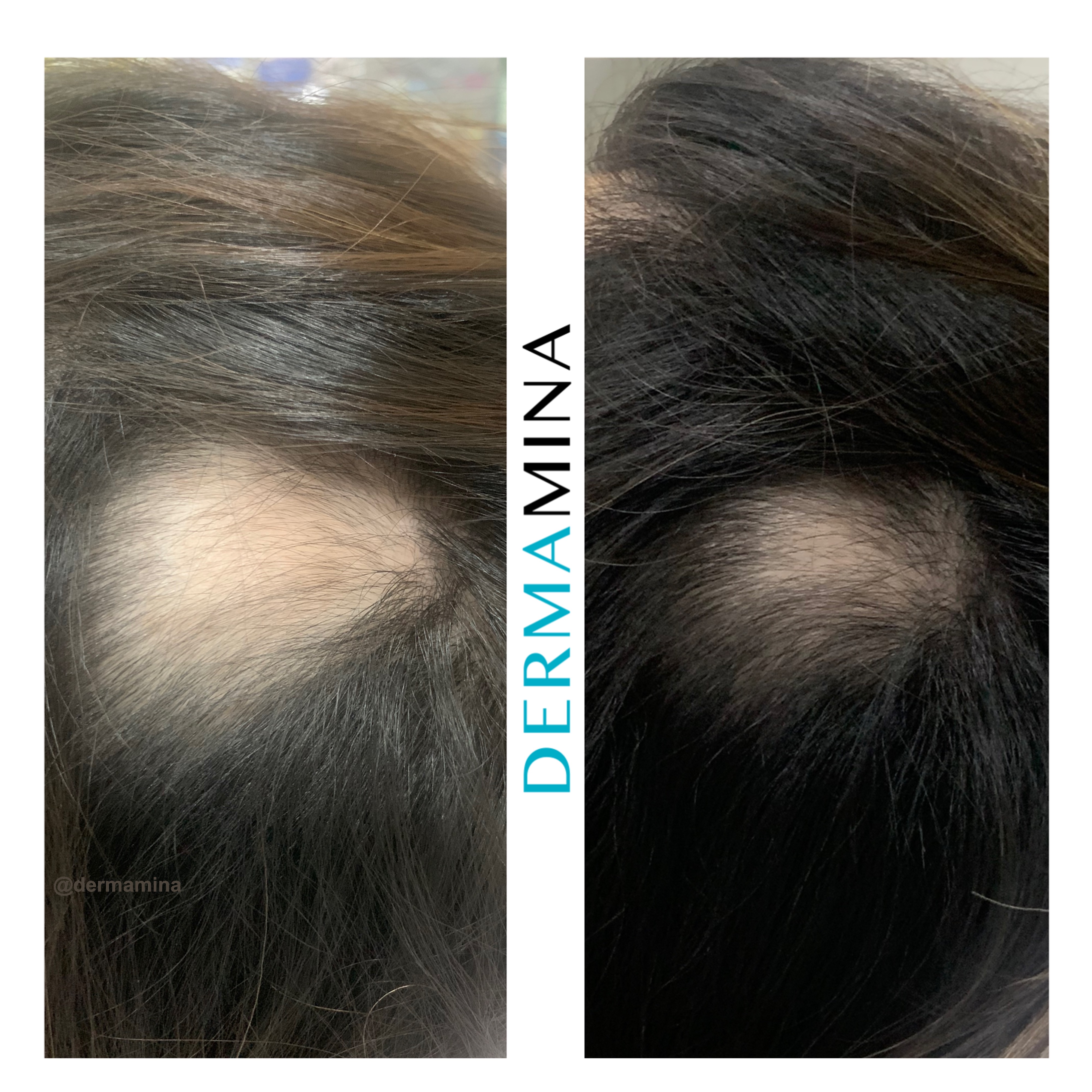 Hair Loss Treatment Before and After