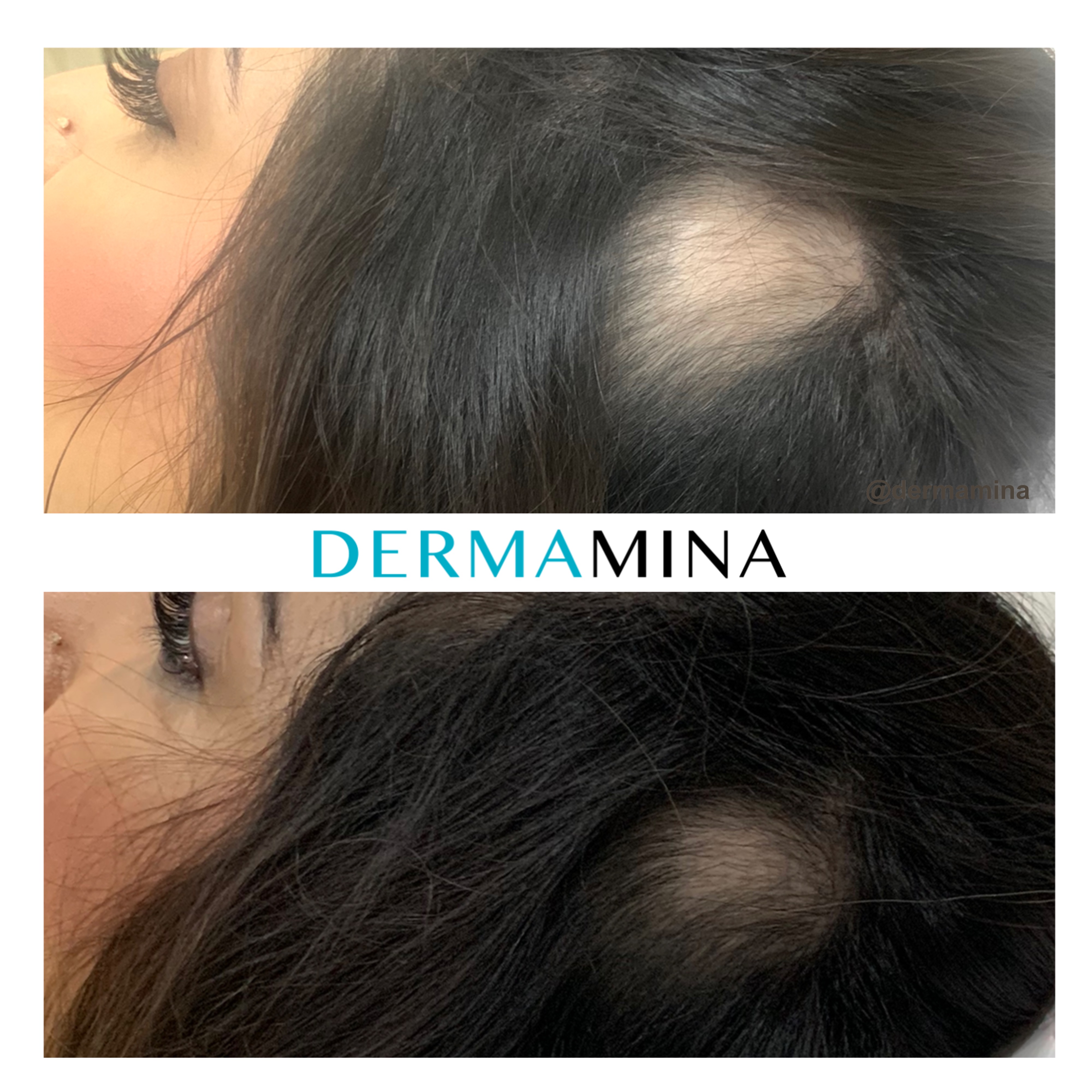 Hair Loss Treatment Before and After