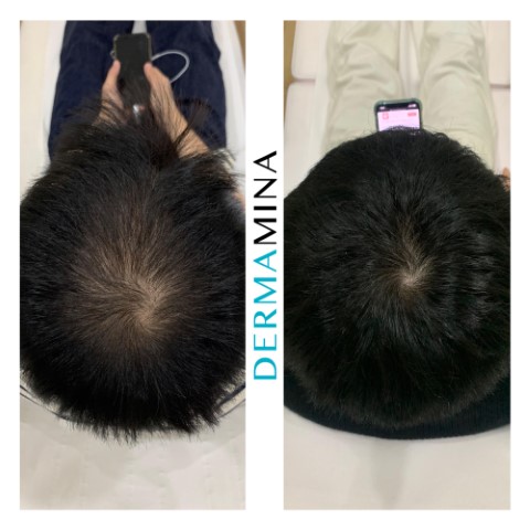 Hair Loss Treatment Before and After