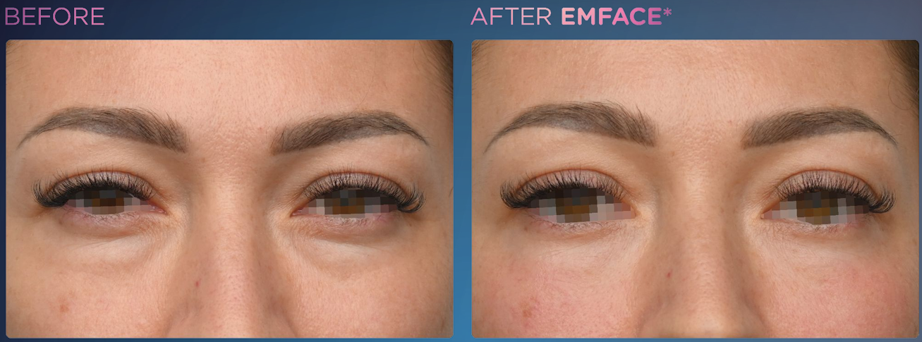 Before and After