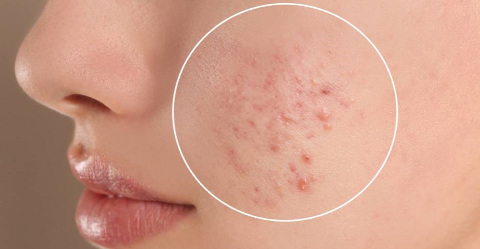 Acne / Active Acne