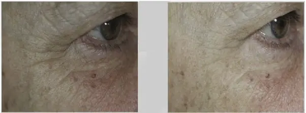 Before and after Nctf Biorevitaliser