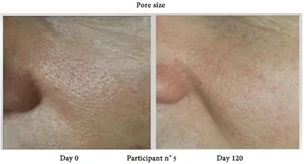 Before and after Nctf Biorevitaliser