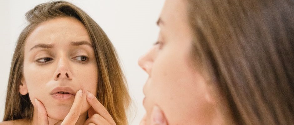 Blackheads