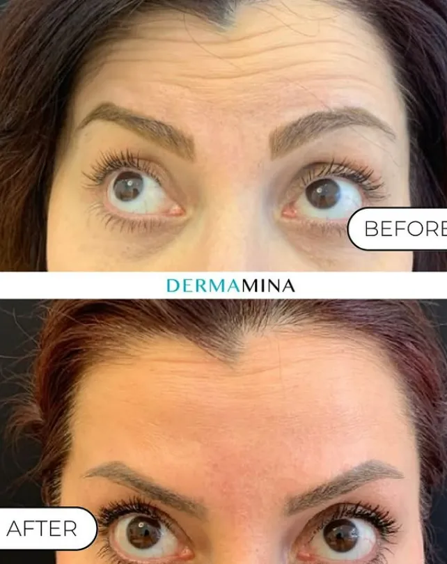 Before and After