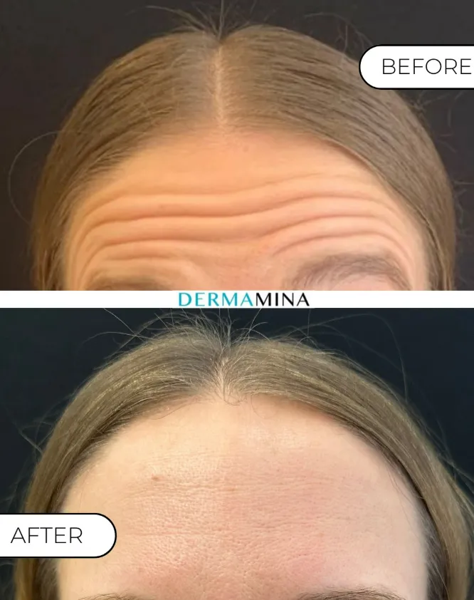 Before and After