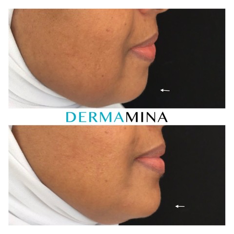 Before & After 10