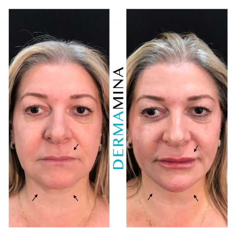 Before & After 12