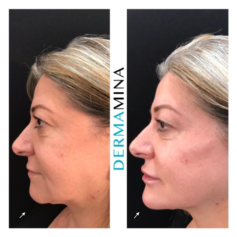 Before & After 13