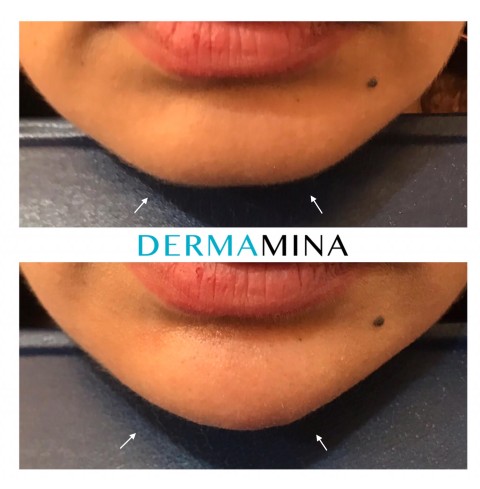 Before & After 14