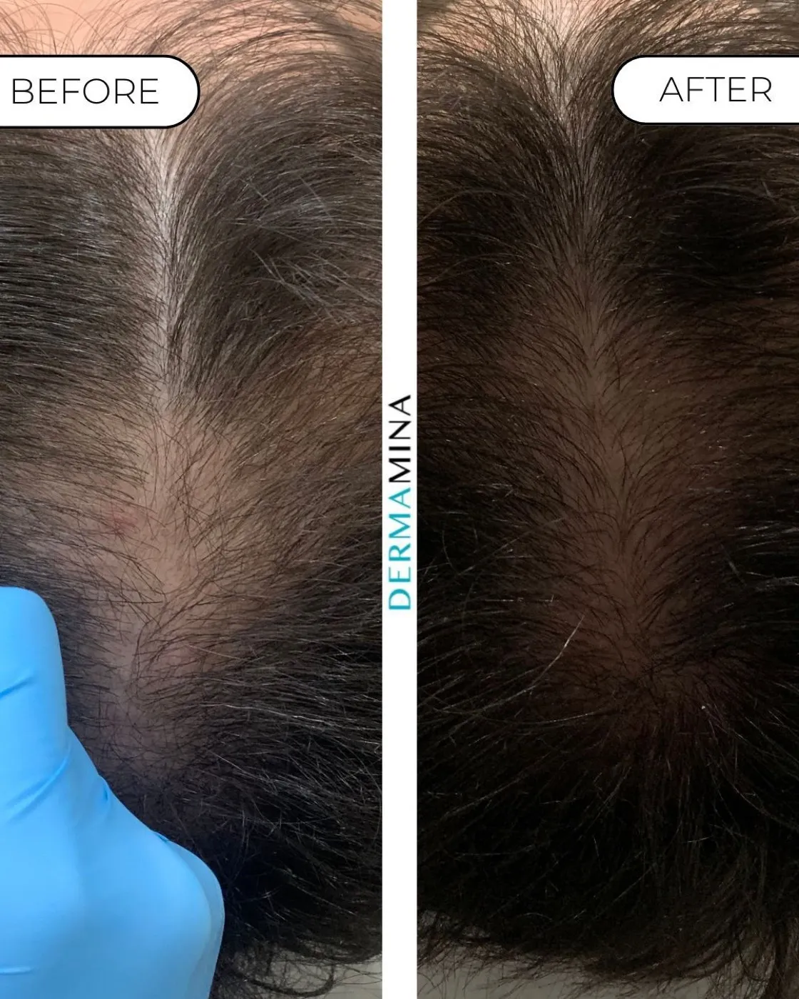 Exosomes hair loss before and after at Dermamina London, denser coverage across a thinning crown and parting