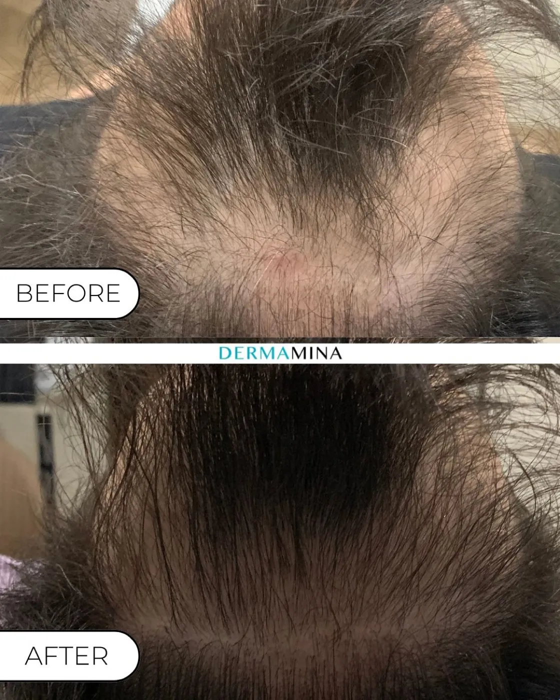 Exosomes hair loss before and after at Dermamina London, new growth filling in a thinning vertex