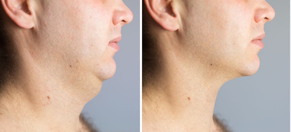 Before & After 1
