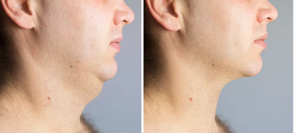 Fat Dissolving Results Timeline