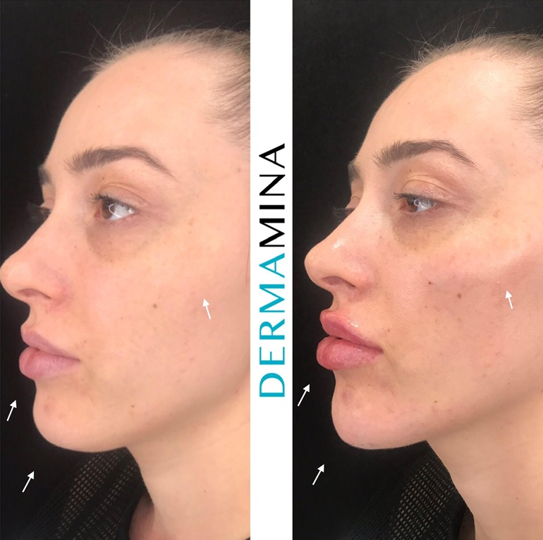 Before & After 1