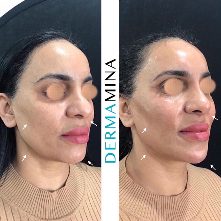 Before & After 5