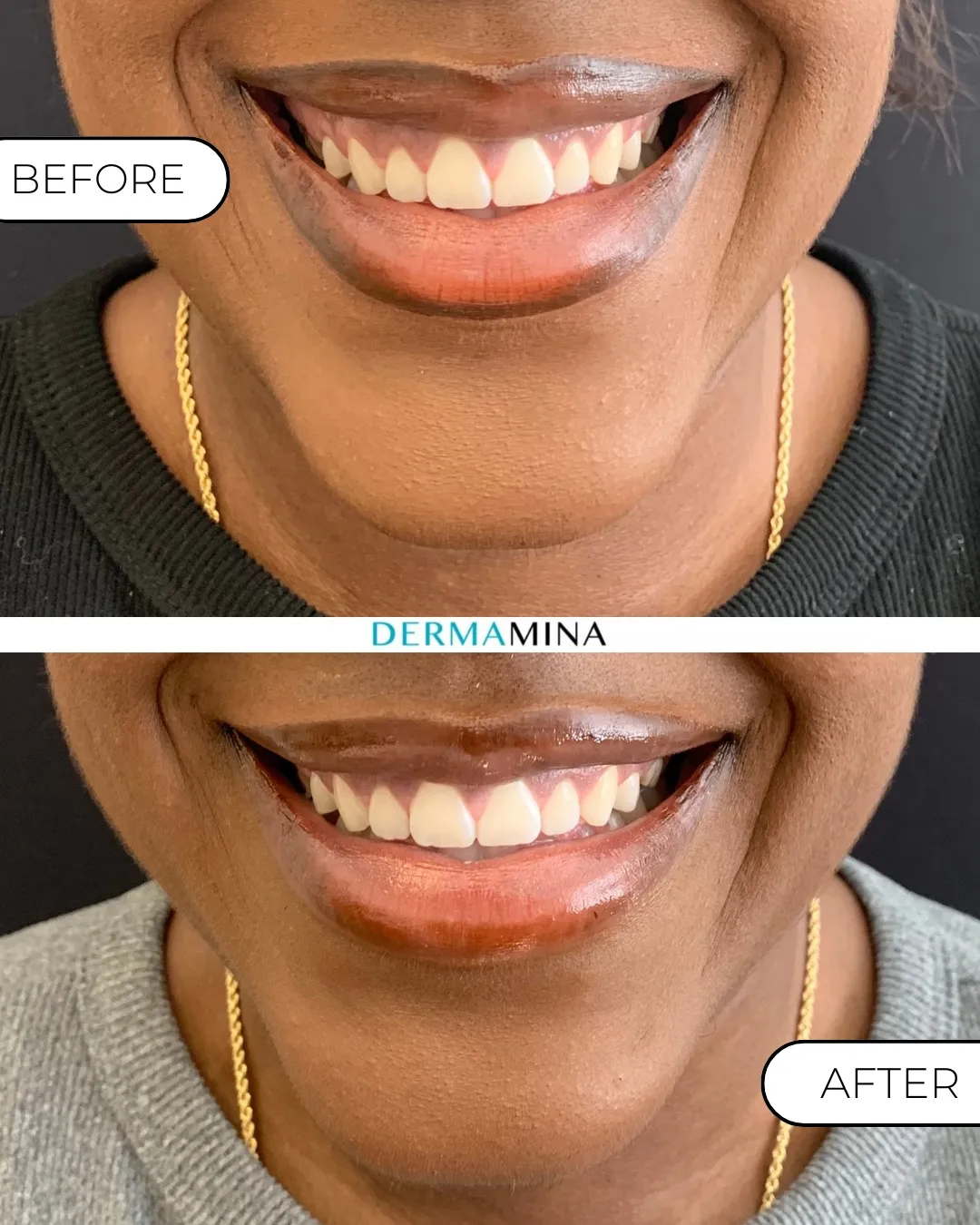 Before and After