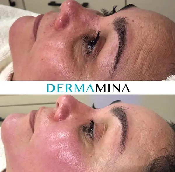 Before and after Hydrafacial