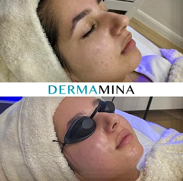 Before and after Hydrafacial