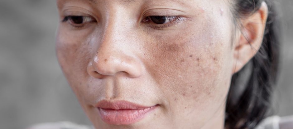 Hyperpigmentation