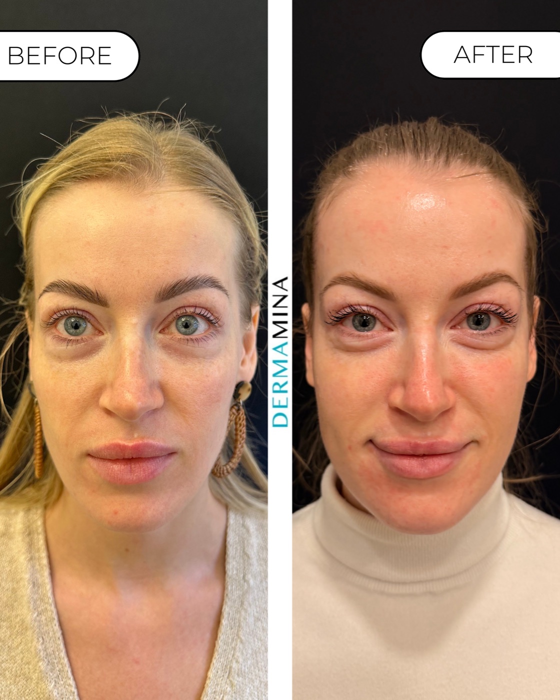 Korean Glass Skin before and after at Dermamina London, brighter and more even skin tone across the full face