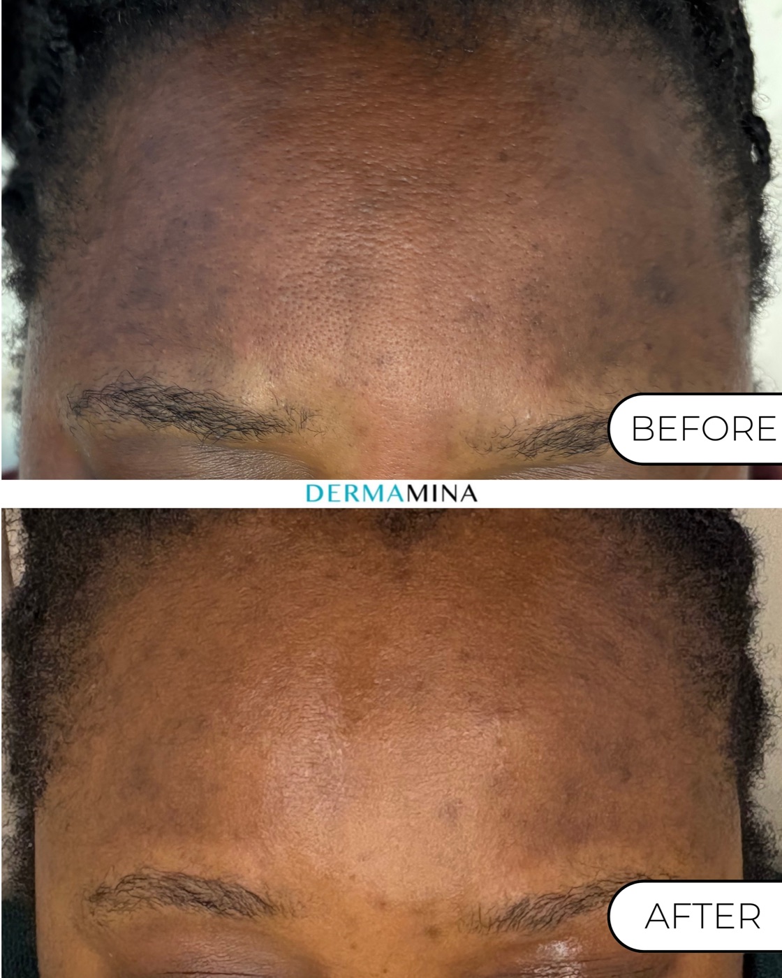 Korean Glass Skin before and after at Dermamina London, pigmentation and texture across the forehead on deeper skin