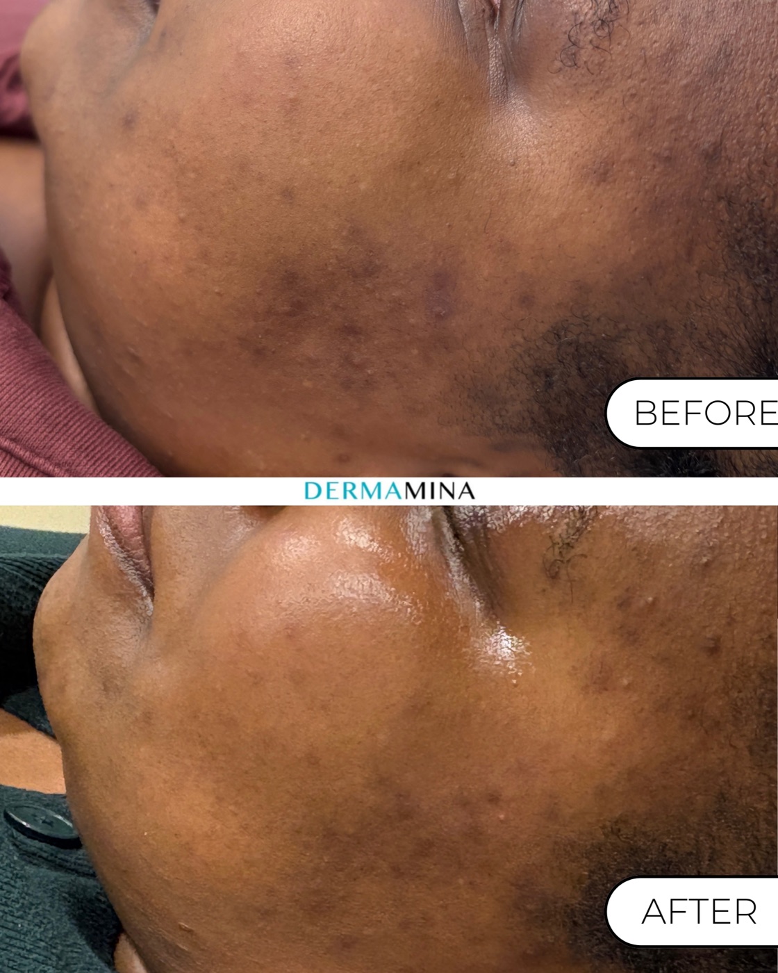 Korean Glass Skin before and after at Dermamina London, post-inflammatory pigmentation along the cheek and jaw