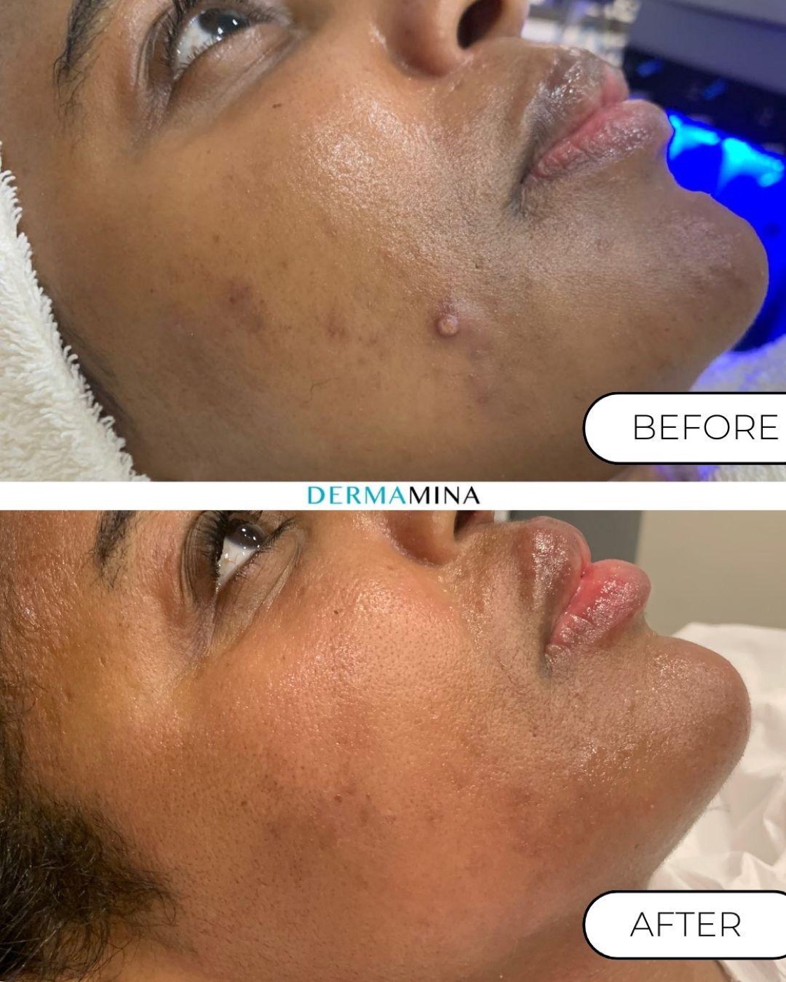 Korean Glass Skin before and after at Dermamina London, acne marks softened and skin left visibly luminous