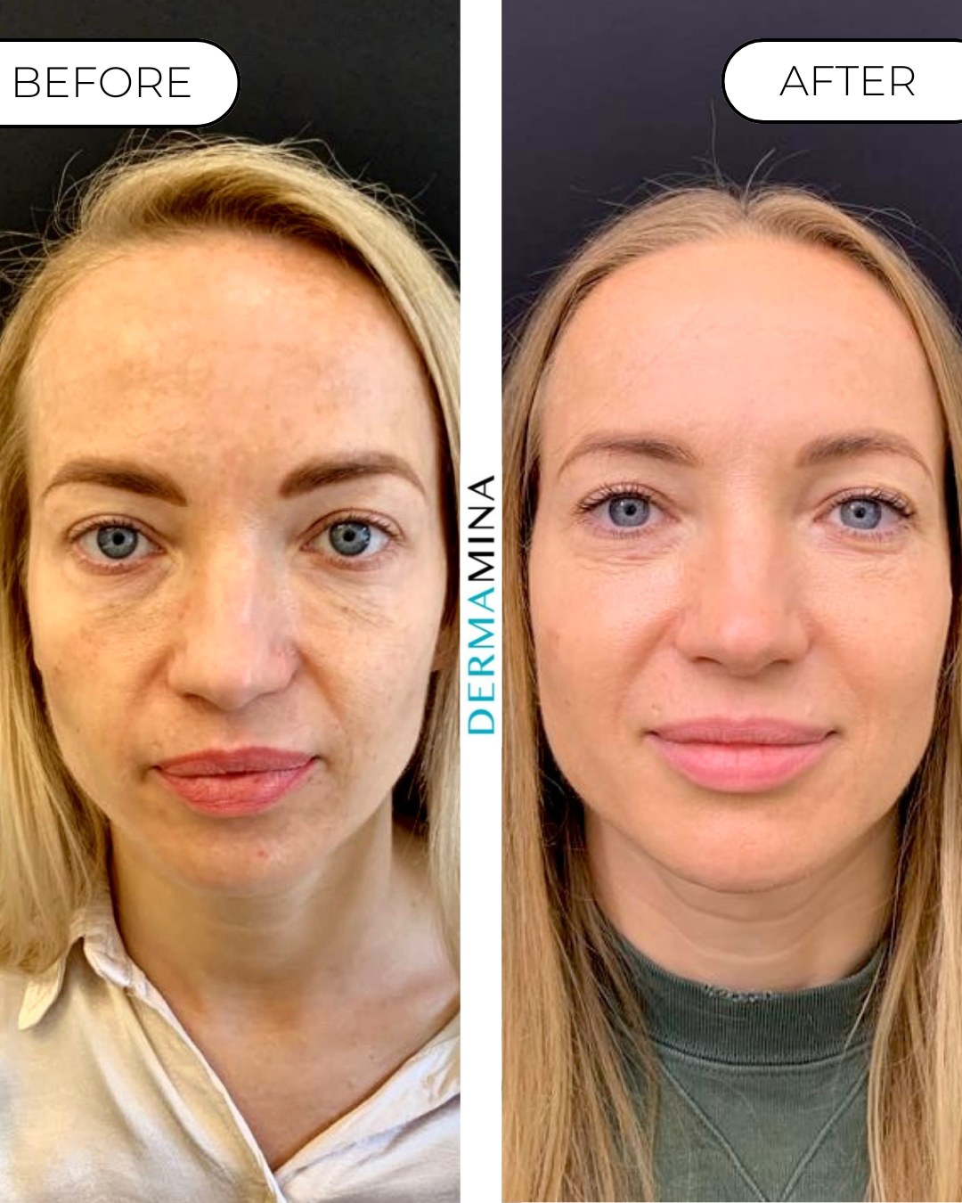 LaseMD Ultra before and after at Dermamina London, sun damage and uneven tone across the face