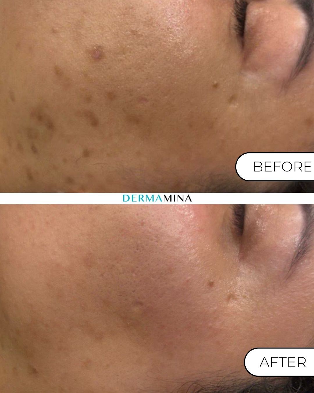LaseMD Ultra with exosomes before and after at Dermamina London, acne scarring and marks on the cheek