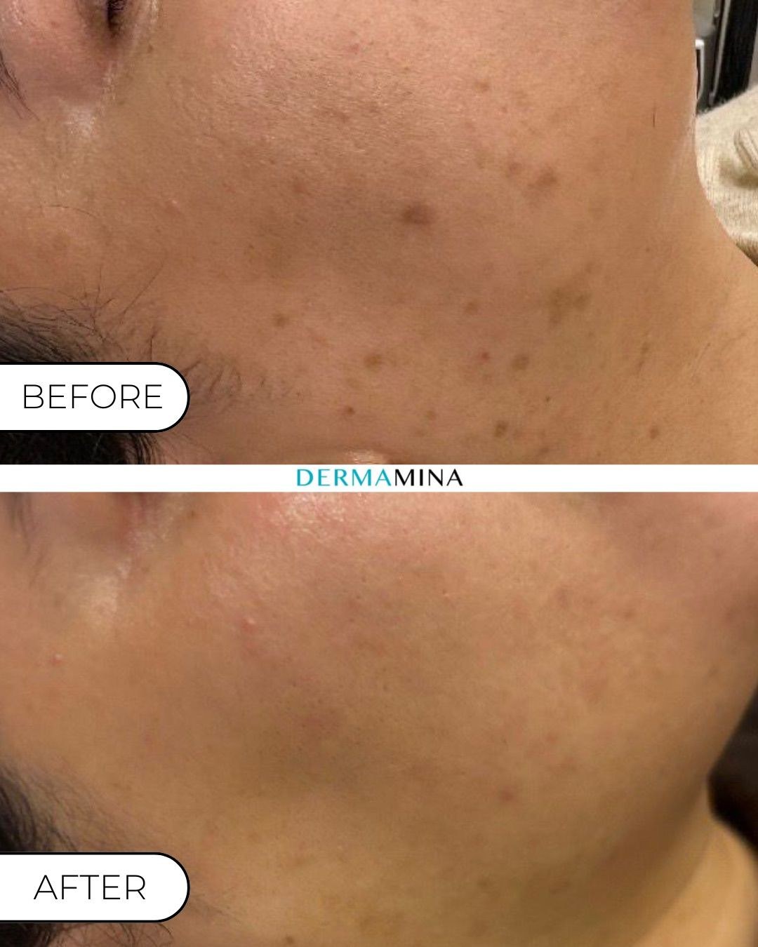 LaseMD Ultra with exosomes before and after at Dermamina London, pigmentation along the jawline and neck