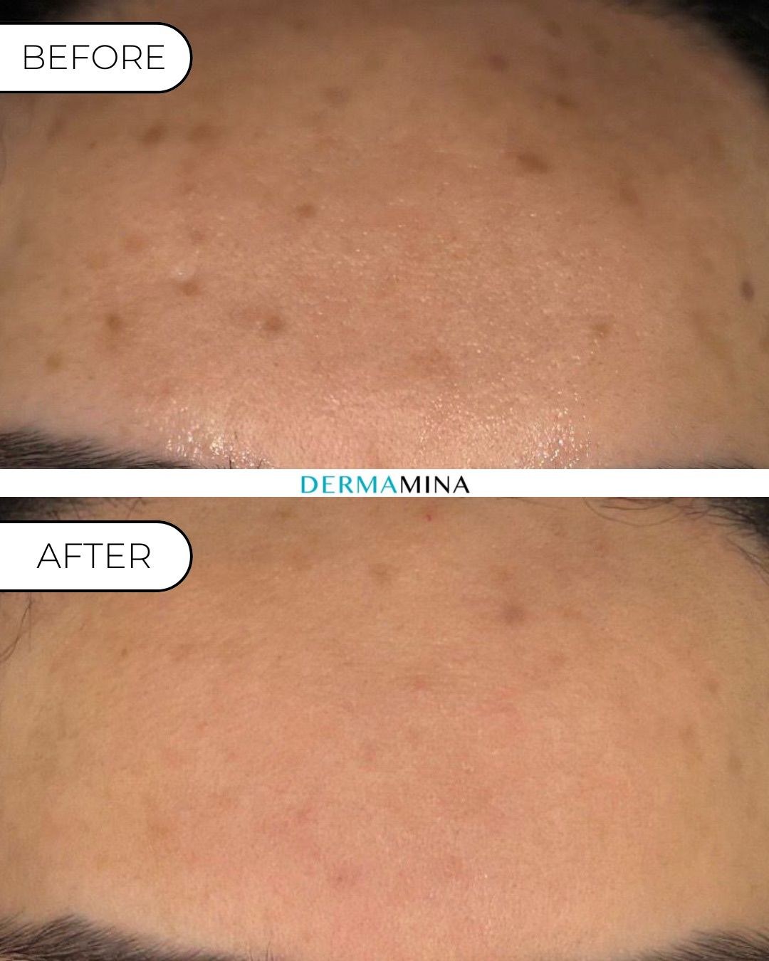 LaseMD Ultra with exosomes before and after at Dermamina London, pigmentation across the forehead