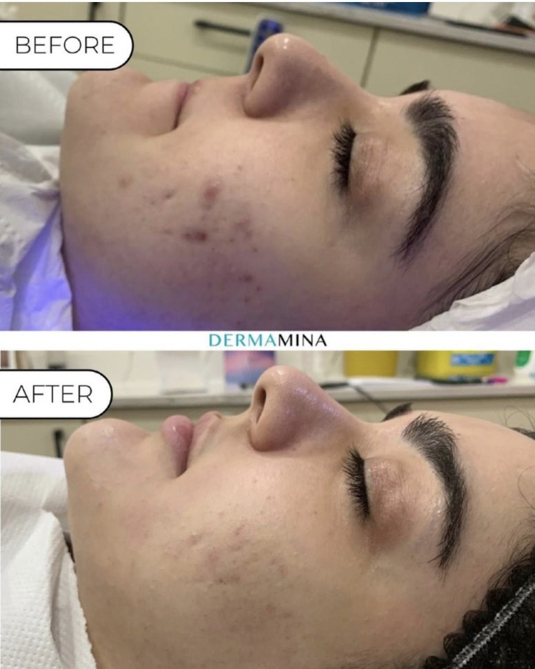 LaseMD Ultra before and after at Dermamina London, active acne and red marks on the cheek