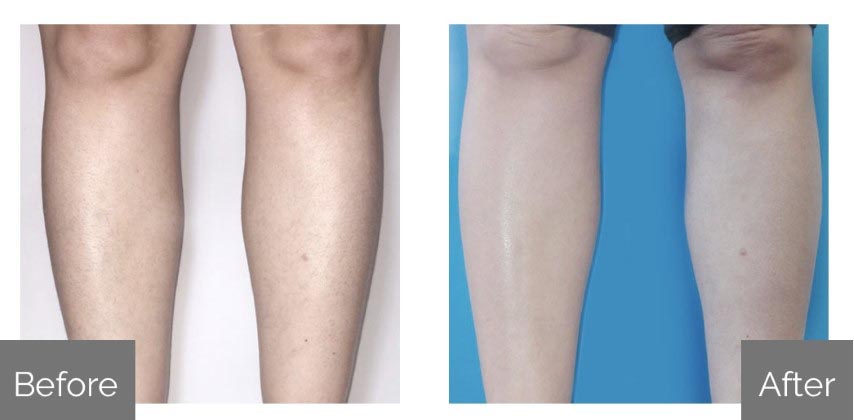 Before & After 4