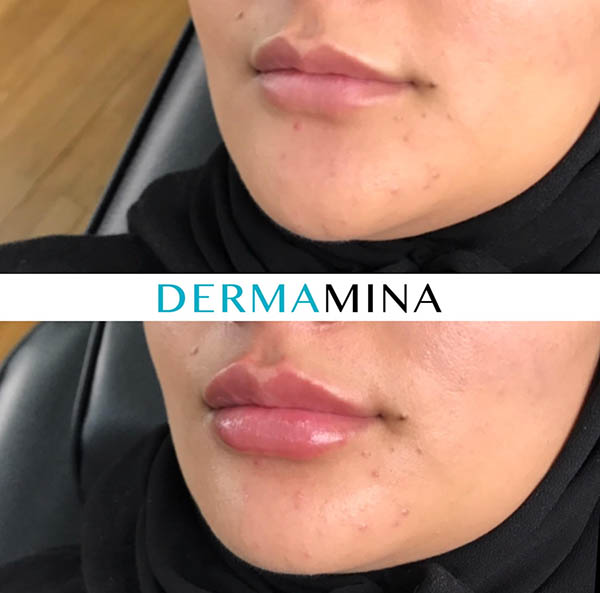 Before & After 14