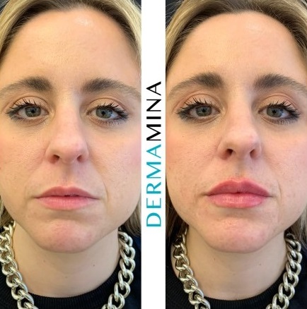 Before & After 24