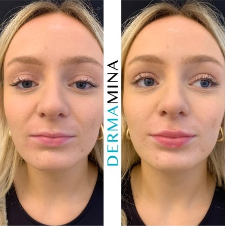 Before & After 26