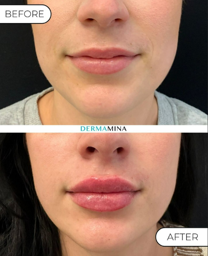 Before and After