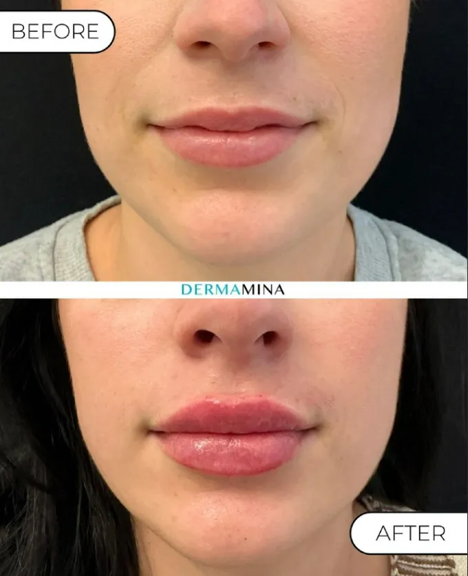 Before and After