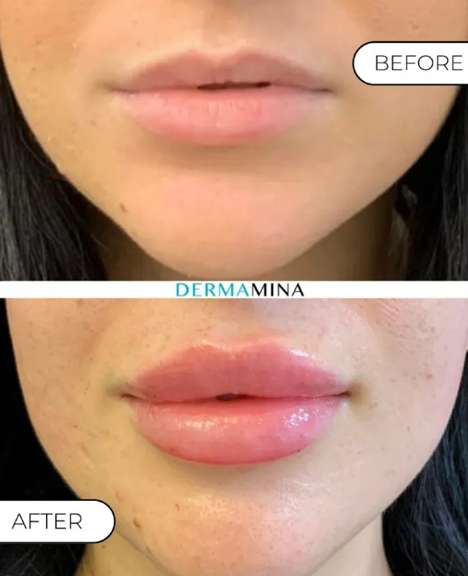 Before and After