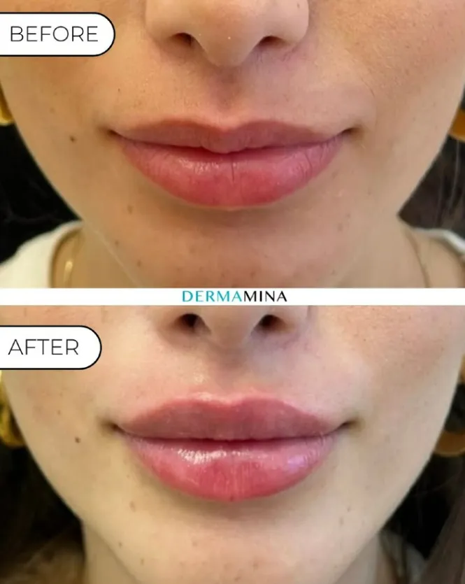 Before and After